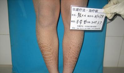 杭州男孩治好魚鱗考上大學自由綻放